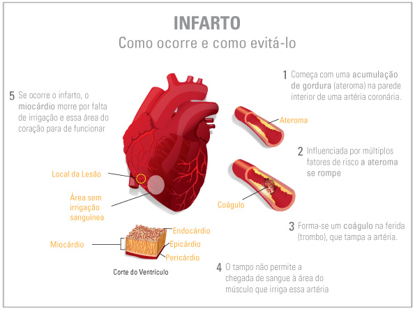 Resultado de imagem para o que é o infarto